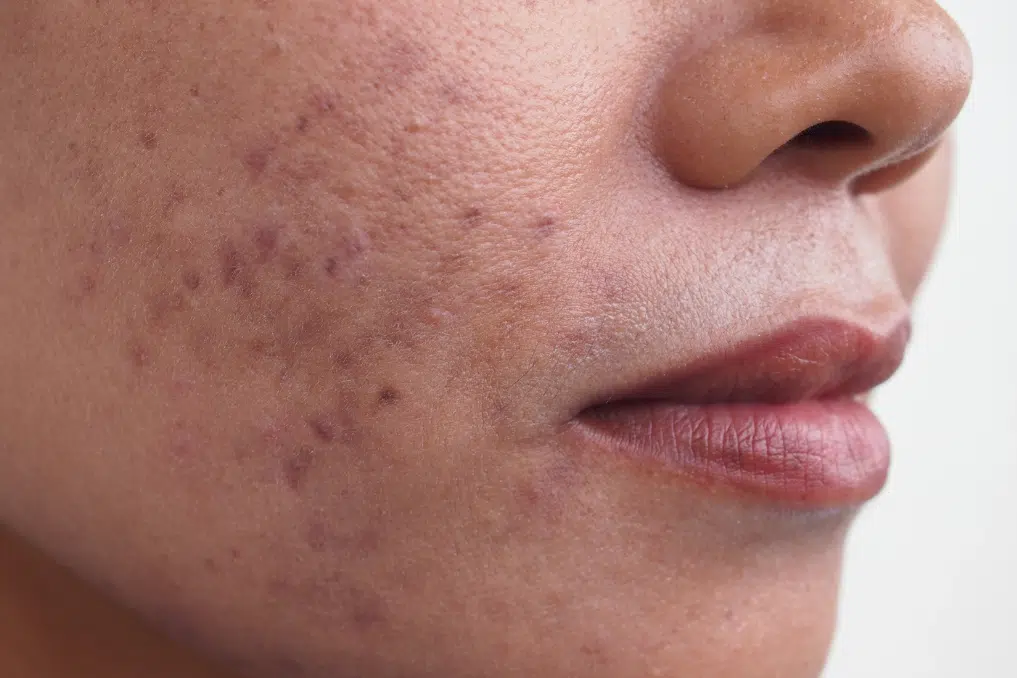 Skin School: What is hyperpigmentation and how can you treat it?